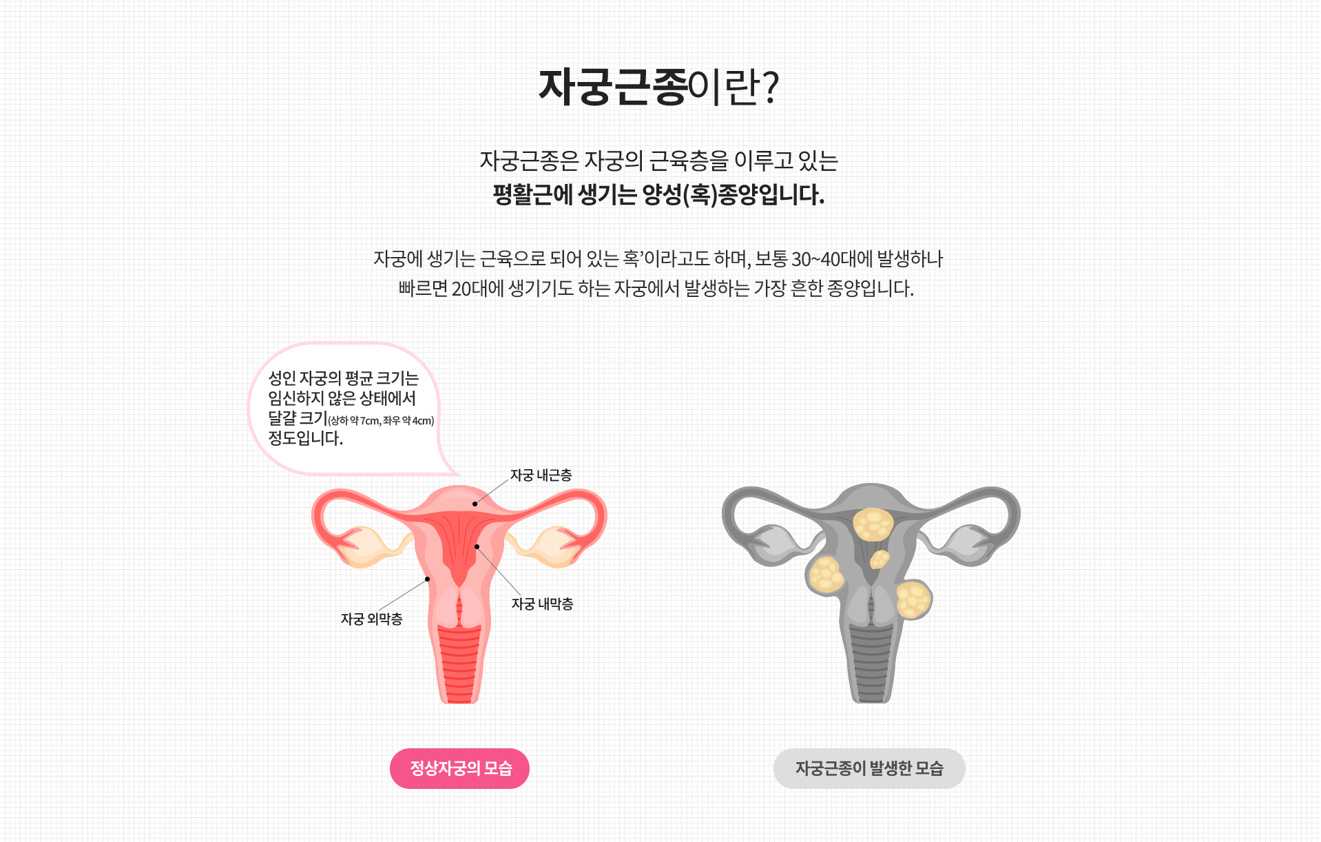 복강경센터 자궁근종이란?