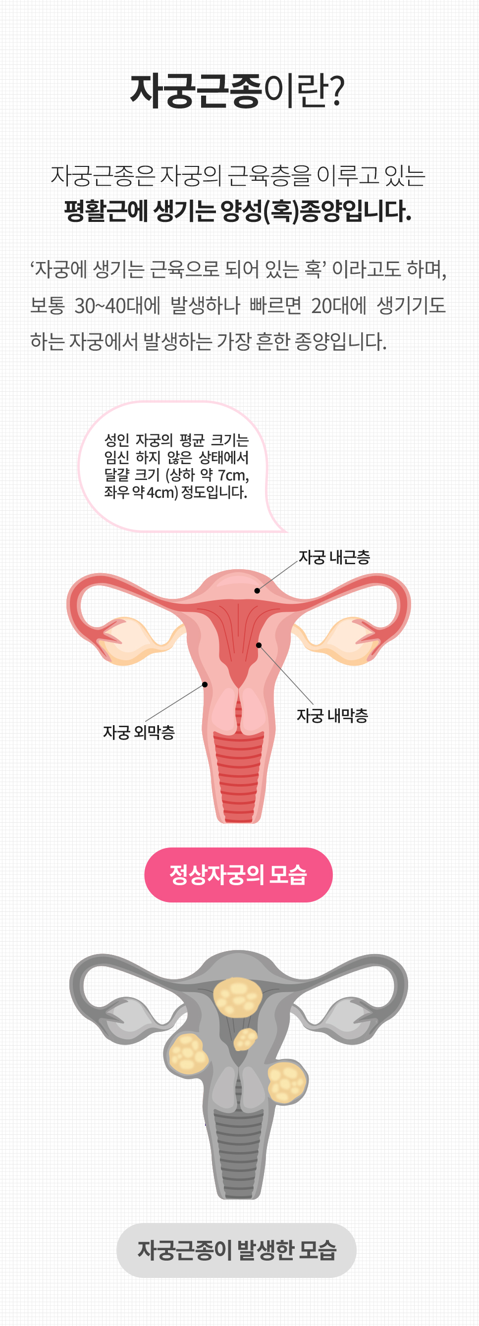 복강경센터 자궁근종이란?