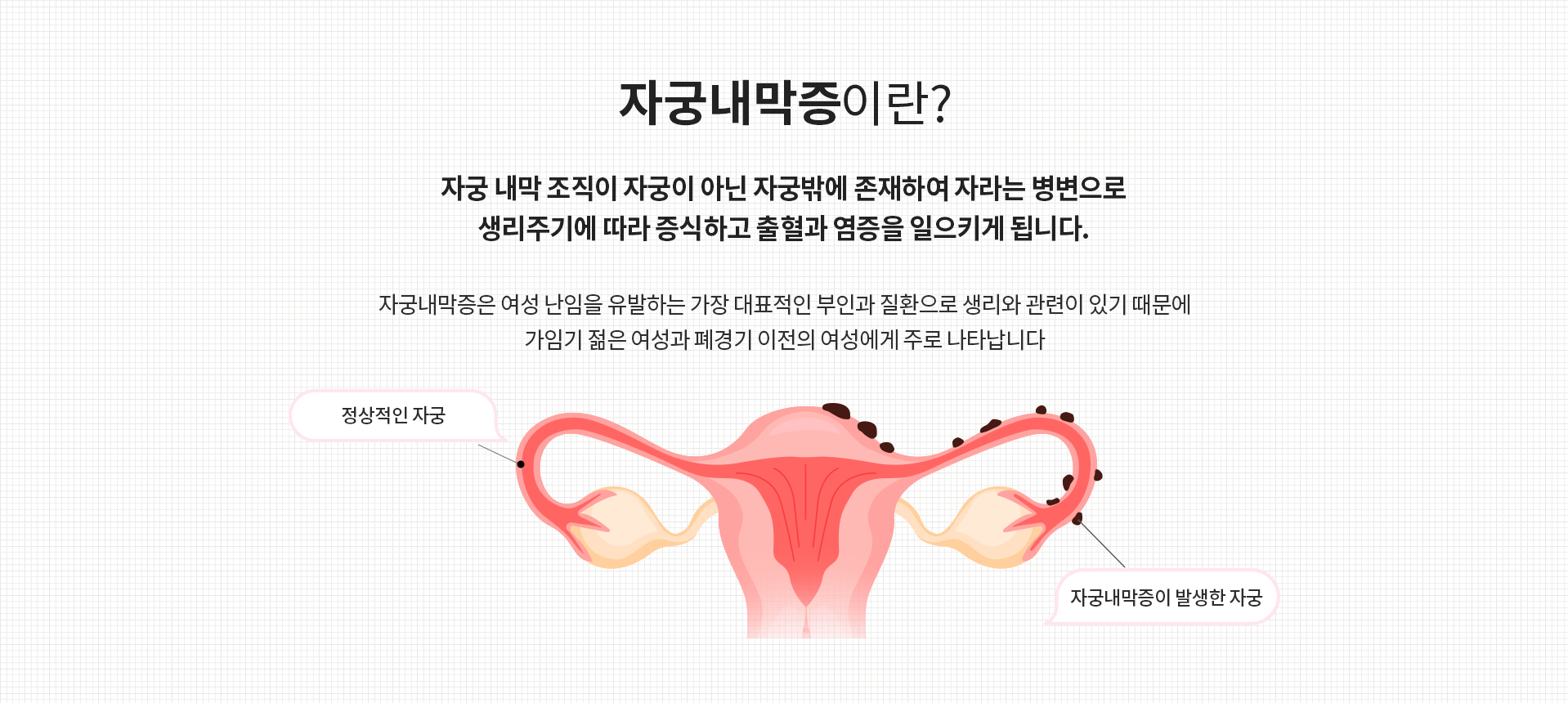 복강경센터 자궁내막증이란?